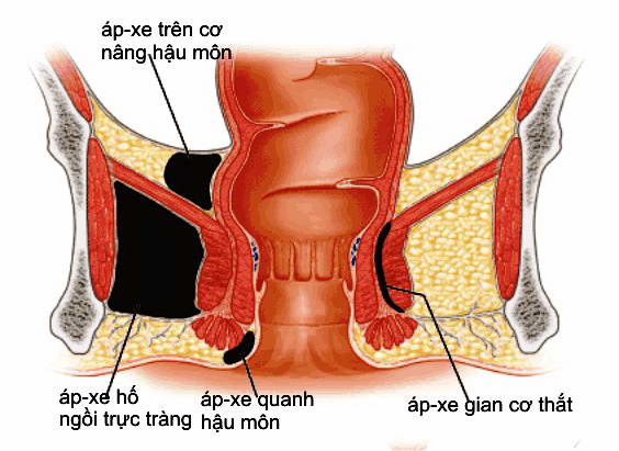 Bệnh Áp-xe hậu môn là gì