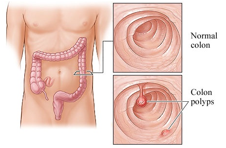 Bệnh Polyp hậu môn là gì