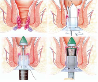 Các phương pháp điều trị bệnh trĩ ngoại