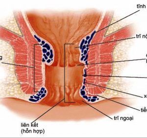 Nguyên nhân Bệnh trĩ nội