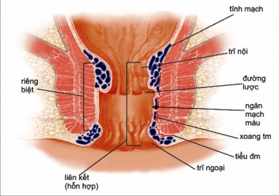 Nguyên nhân Bệnh trĩ nội