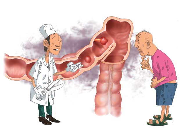 Nguyên nhân gây Bệnh Polyp hậu môn