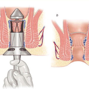 Các phương pháp điều trị bệnh trĩ nội