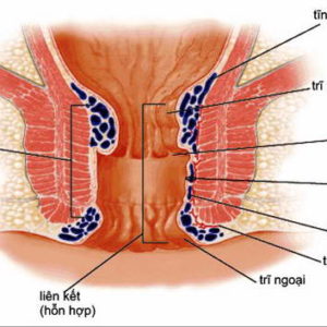 Cách trị bệnh trĩ ngoại tại nhà