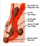 Các triệu chứng của Áp-xe hậu môn