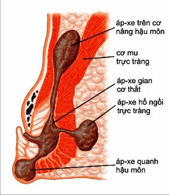 Các triệu chứng của Áp-xe hậu môn