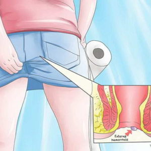 Bệnh ngứa hậu môn