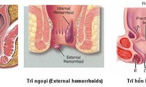 Biểu hiện của bệnh trĩ hỗn hợp