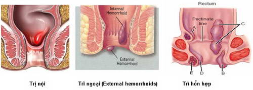 Biểu hiện của bệnh trĩ hỗn hợp