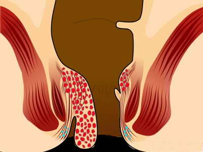 Phương pháp điều trị bệnh trĩ nội ứng với từng giai đoạn Phương pháp điều trị bệnh trĩ nội ứng với từng giai đoạn