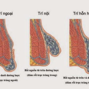 Phương pháp điều trị bệnh trĩ hỗn hợp