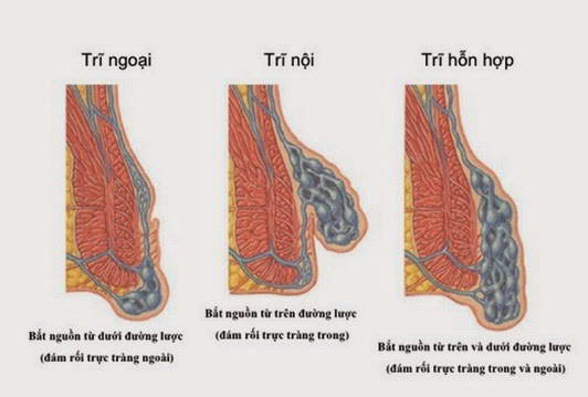 Phương pháp điều trị bệnh trĩ hỗn hợp