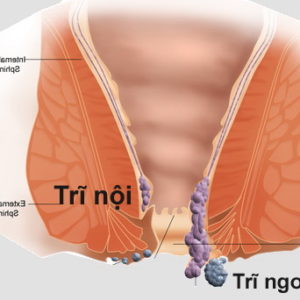 Làm gì khi bị trĩ