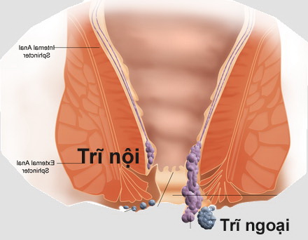 Làm gì khi bị trĩ?