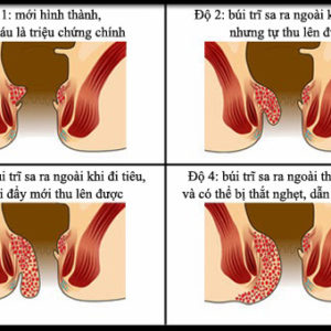 Phân biệt trĩ lòi và lòi hậu môn