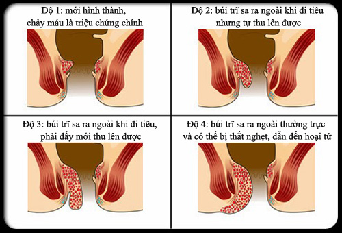 Phân biệt búi trĩ sa và lòi hậu môn