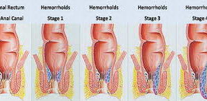 Búi trĩ và nhận biết búi trĩ