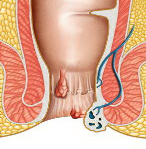 Nhận biết trĩ tắc mạch