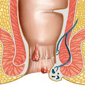 Nhận biết trĩ tắc mạch