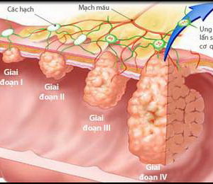 Cách phân biệt bệnh trĩ và bệnh ung thư đại tràng