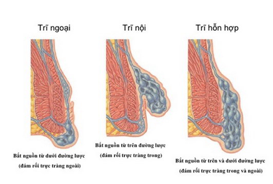 Phân loại trĩ