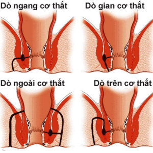 Rò hậu môn xuyên cơ thắt là gì