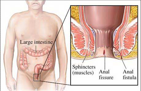 Tác hại của rò hậu môn