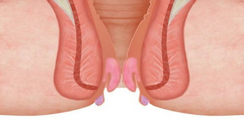 Làm thế nào để búi trĩ co lên nhanh nhất