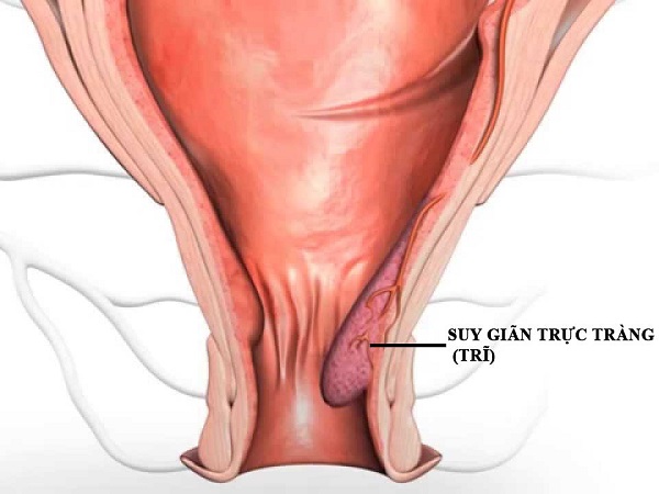 Hiểu về suy giãn tĩnh mạch hậu môn