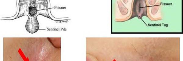 Hình ảnh nứt kẽ hậu môn qua các giai đoạn