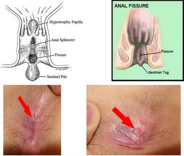 Hình ảnh nứt kẽ hậu môn qua các giai đoạn