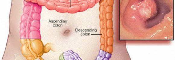 Đừng nhầm bệnh trĩ với ung thư hậu môn