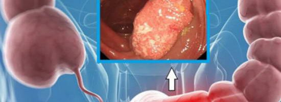 Liệu bệnh trĩ có gây ra tình trạng ung thư?