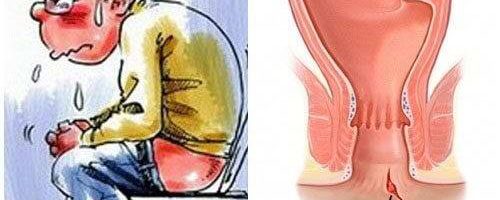 Rách, nứt hậu môn là gì? Phương pháp điều trị như thế nào?