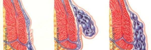 Biểu hiện trĩ hỗn hợp là gì?