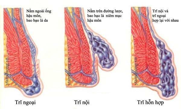 Biểu hiện trĩ hỗn hợp là gì?