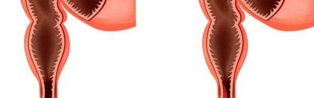 Sa trực tràng có tự khỏi không?