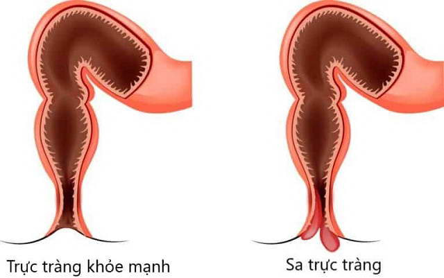 Sa trực tràng có tự khỏi không?