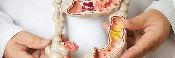 Nhiều người Việt thành “con mồi” của ung thư đại tràng vì những thói quen này