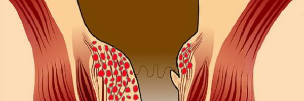 Bệnh trĩ ra máu và cách xử lý