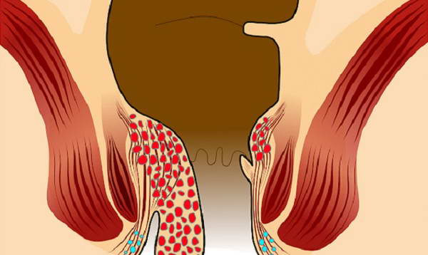 Bệnh trĩ ra máu và cách xử lý