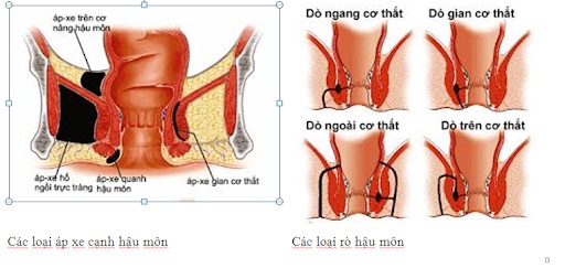 Bệnh rò hậu môn nhẹ có tự khỏi không