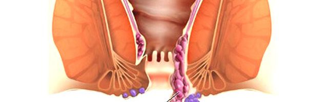 Hiểu về bệnh trĩ qua từng giai đoạn