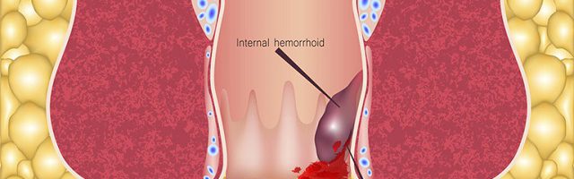 Đối tượng mắc bệnh trĩ ngày càng trẻ hóa