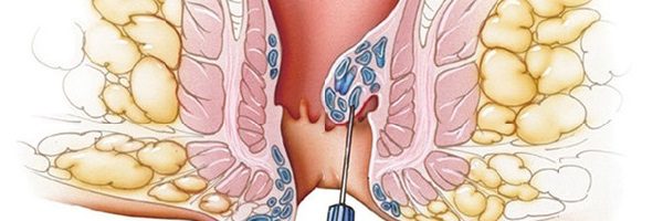 Trĩ nội có polyp là gì?