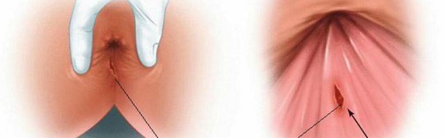 Vì sao sản phụ bị nứt kẽ hậu môn sau sinh?