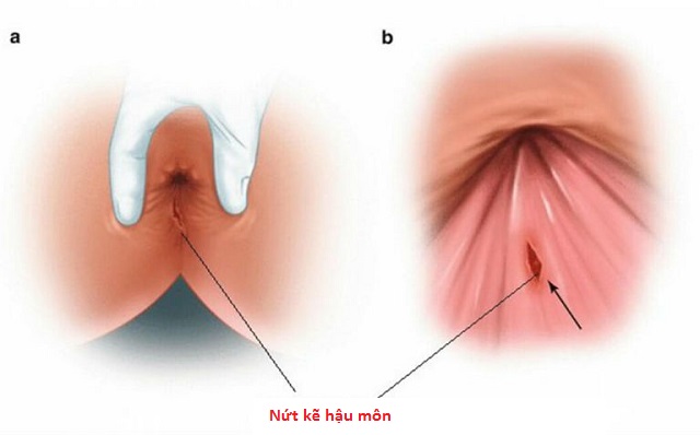 Vì sao sản phụ bị nứt kẽ hậu môn sau sinh?