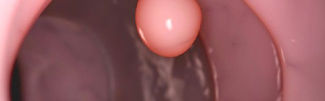 Cắt polyp hậu môn có đau không?