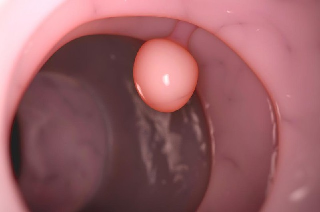 Cắt polyp hậu môn có đau không?