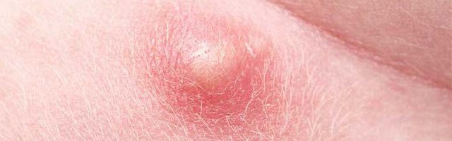 Phân biết áp xe hậu môn và mụn nhọt bình thường